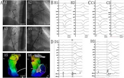 Catheter Ablation of Ventricular Arrhythmias Originating From the Pulmonary Sinus Cusp in Pediatric Patients: A Single-Center Retrospective Study